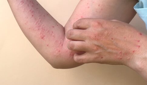 Close-up of a persons arm with red spots and a hand scratching the skin